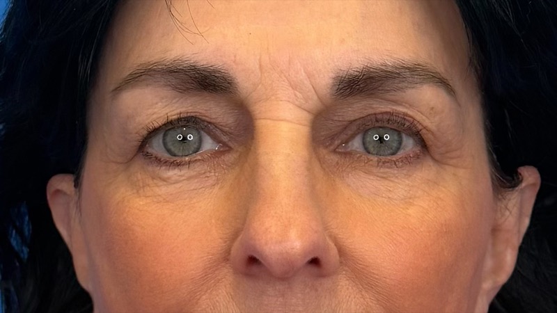 Blepharoplasty Before & After Image
