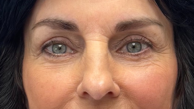 Blepharoplasty Before & After Image