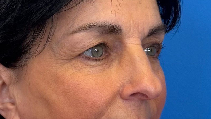 Blepharoplasty Before & After Image