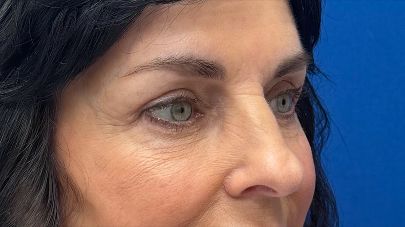 Blepharoplasty Before & After Image
