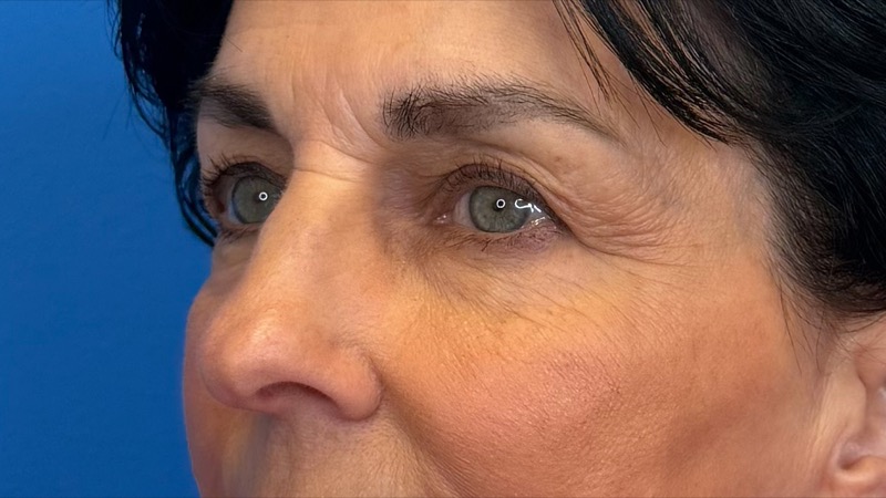 Blepharoplasty Before & After Image