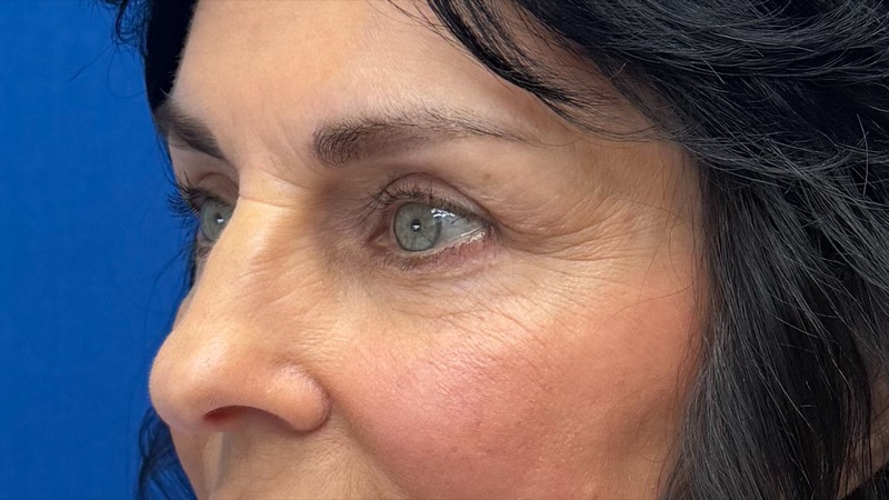 Blepharoplasty Before & After Image