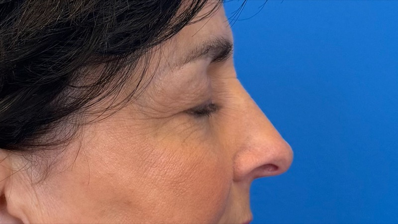 Blepharoplasty Before & After Image