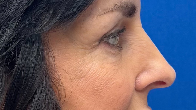 Blepharoplasty Before & After Image