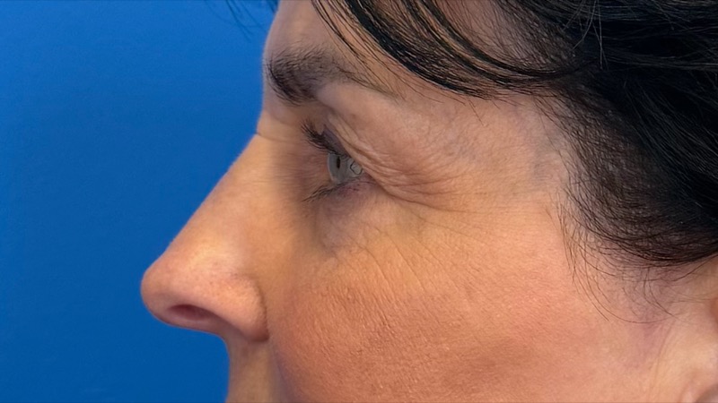 Blepharoplasty Before & After Image