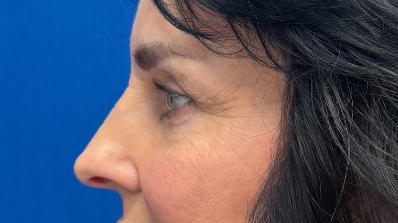Blepharoplasty Before & After Image