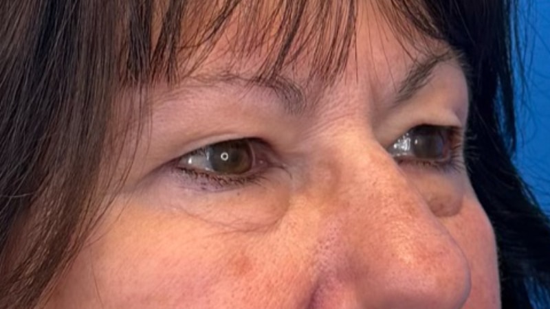 Blepharoplasty Before & After Image
