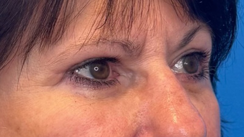 Blepharoplasty Before & After Image