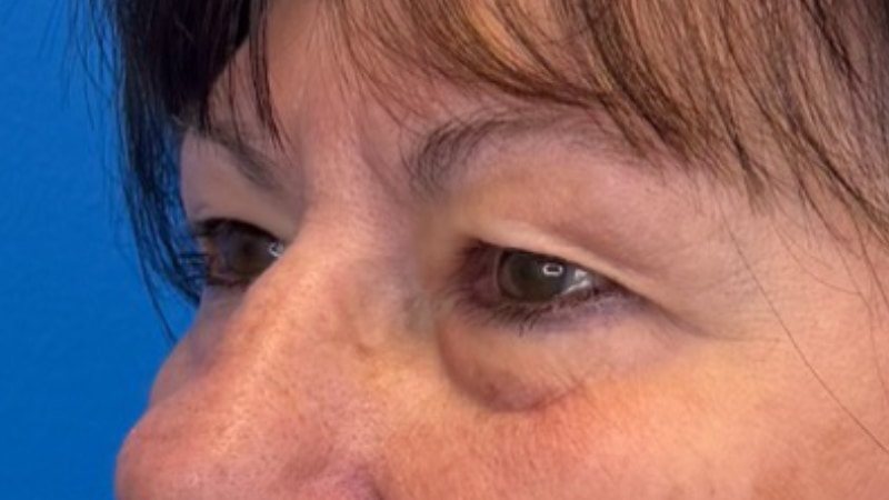 Blepharoplasty Before & After Image
