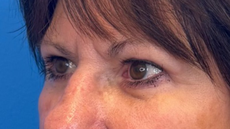Blepharoplasty Before & After Image