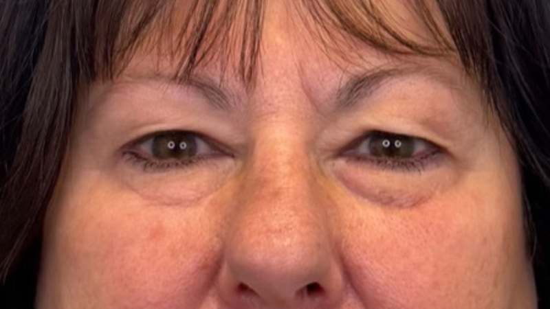 Blepharoplasty Before & After Image