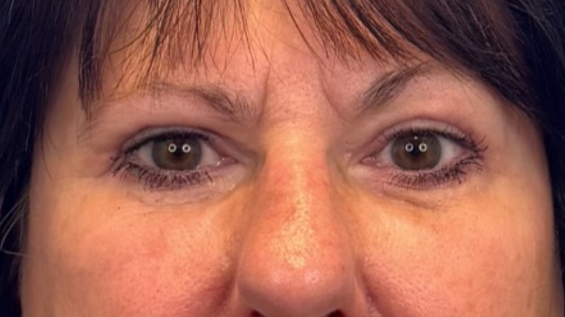 Blepharoplasty Before & After Image