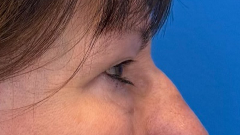 Blepharoplasty Before & After Image