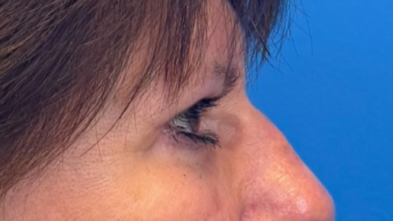 Blepharoplasty Before & After Image