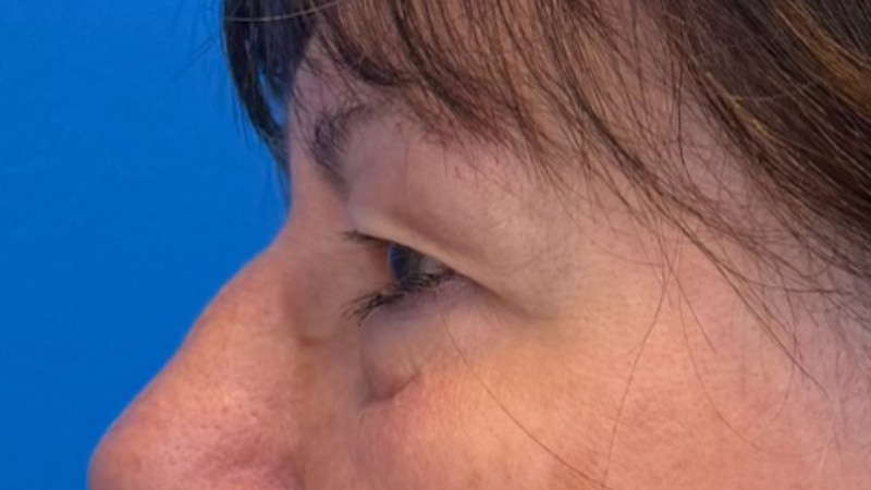 Blepharoplasty Before & After Image
