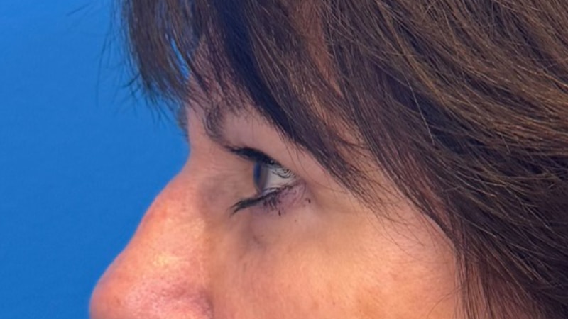 Blepharoplasty Before & After Image