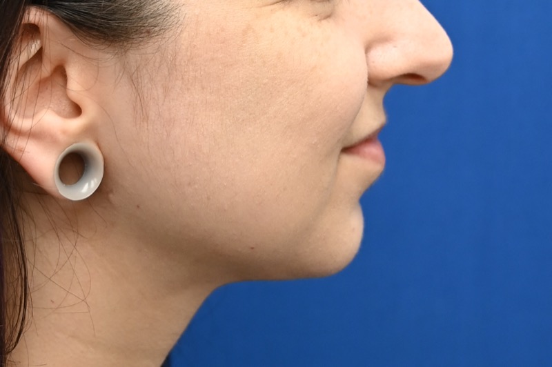 Chin Implants Before & After Image