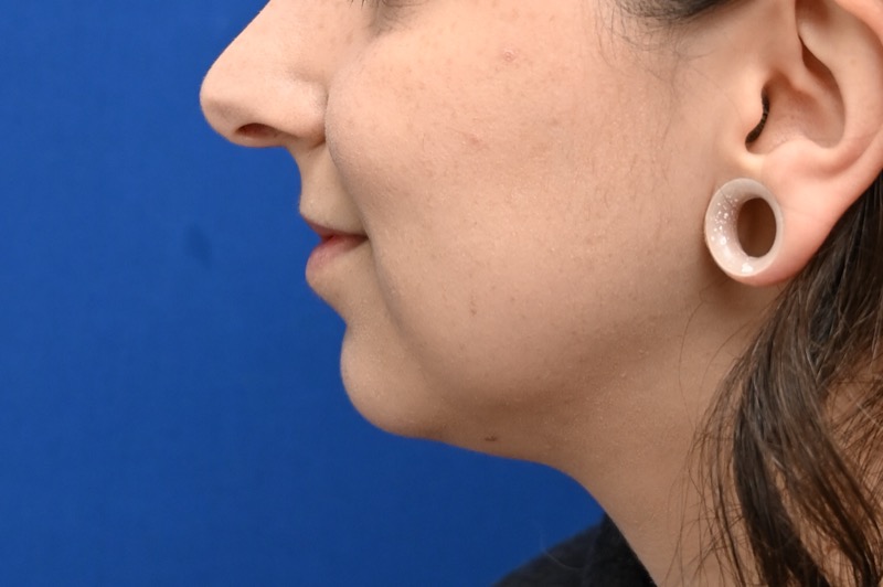 Chin Implants Before & After Image