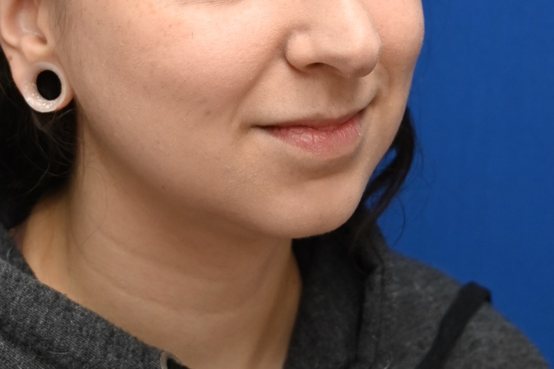 Chin Implants Before & After Image