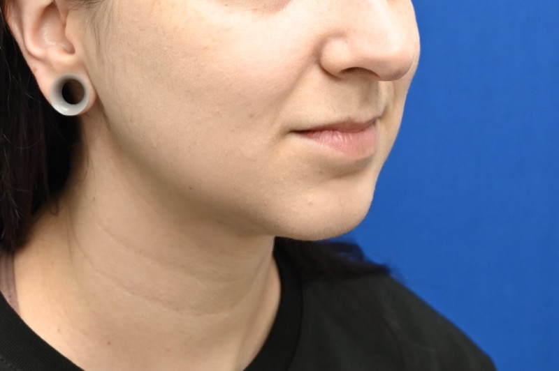 Chin Implants Before & After Image