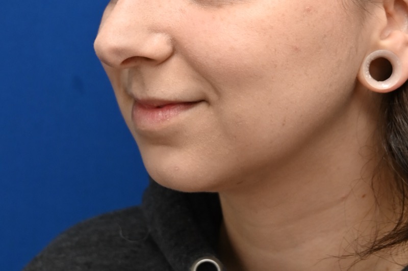 Chin Implants Before & After Image