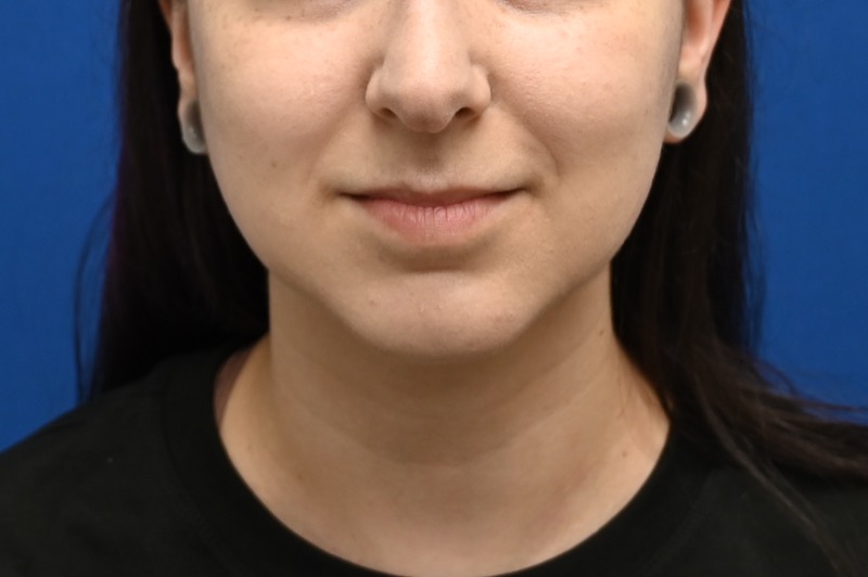 Chin Implants Before & After Image