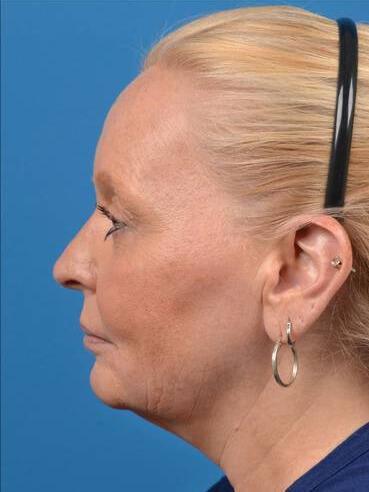 Facelift Before & After Image