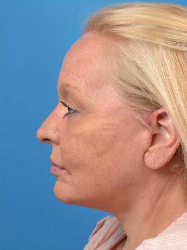 Facelift Before & After Image