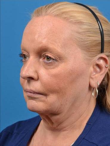 Facelift Before & After Image