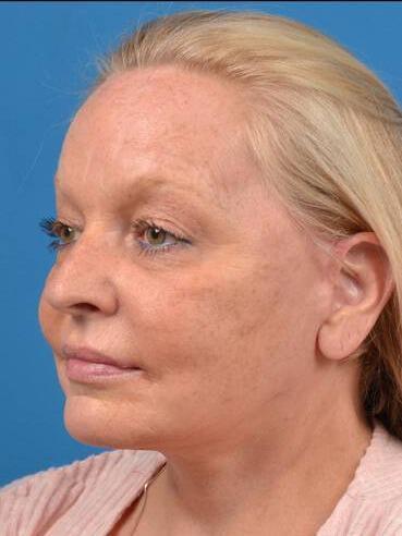 Facelift Before & After Image