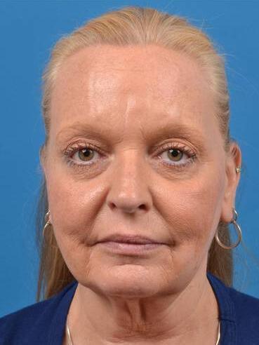 Facelift Before & After Image