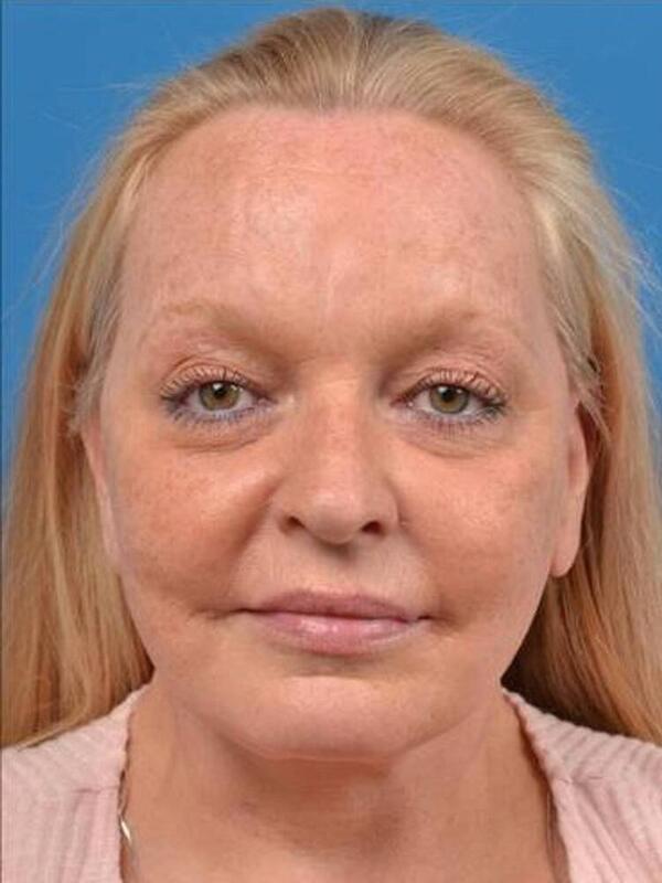 Facelift Before & After Image