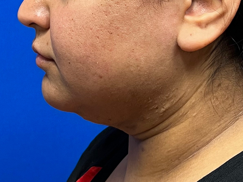 Facial Liposuction Before & After Image