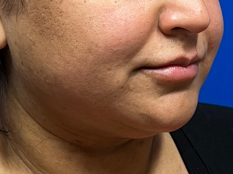 Facial Liposuction Before & After Image