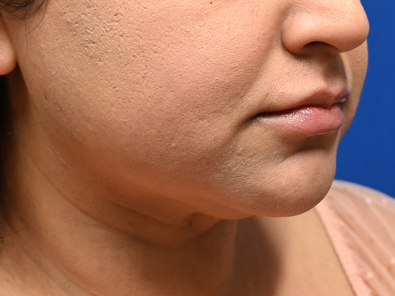 Facial Liposuction Before & After Image