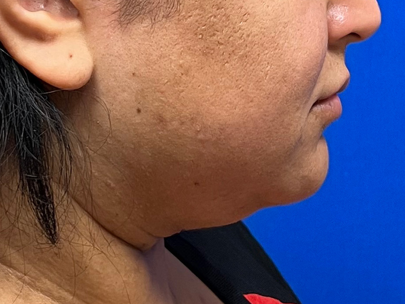 Facial Liposuction Before & After Image