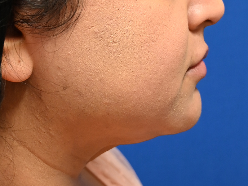 Facial Liposuction Before & After Image