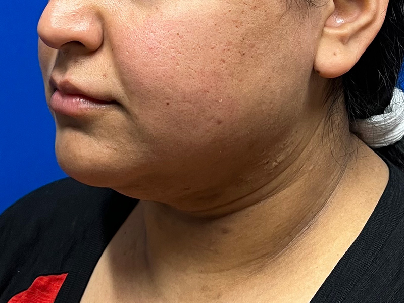 Facial Liposuction Before & After Image