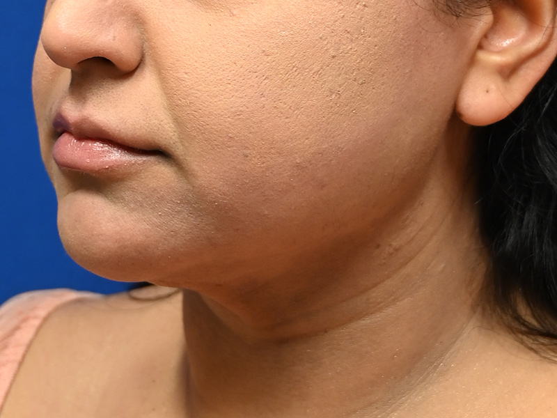 Facial Liposuction Before & After Image