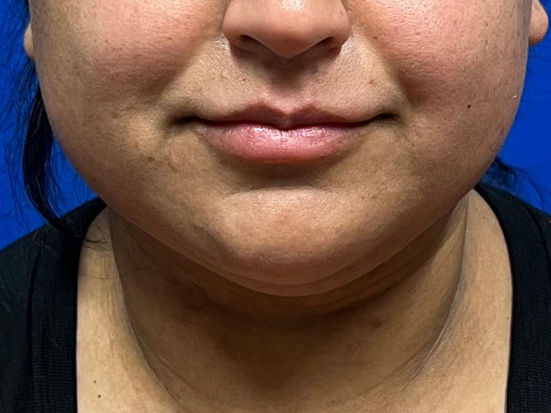 Facial Liposuction Before & After Image