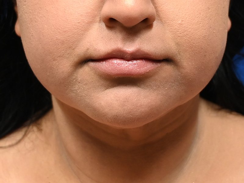 Facial Liposuction Before & After Image