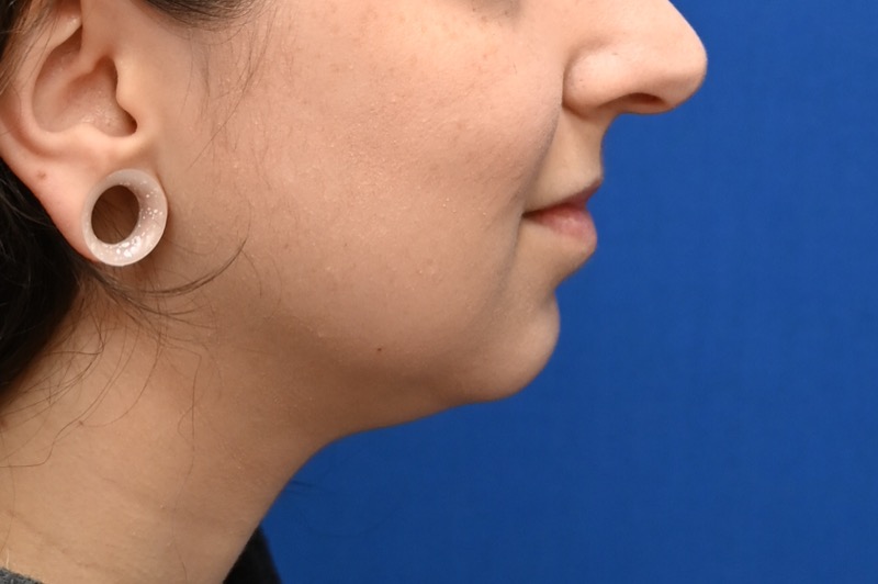 Facial Liposuction Before & After Image