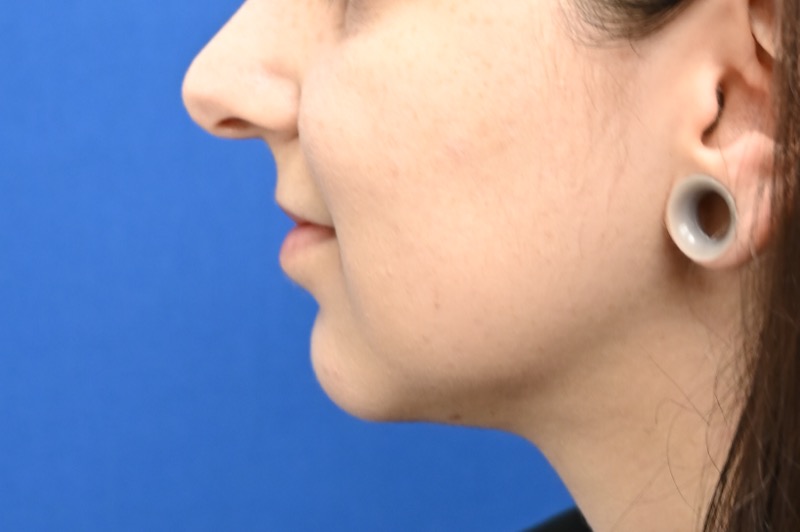 Facial Liposuction Before & After Image