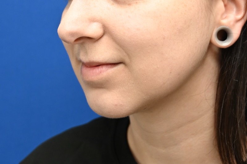 Facial Liposuction Before & After Image