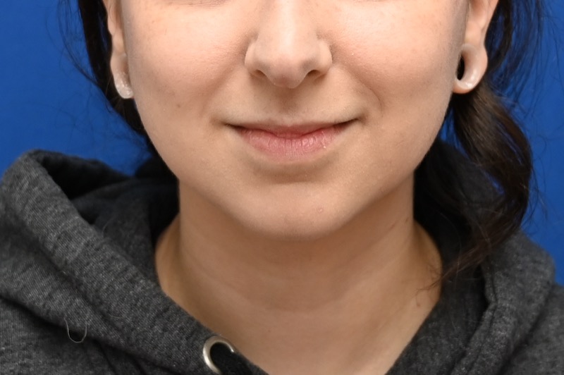 Facial Liposuction Before & After Image