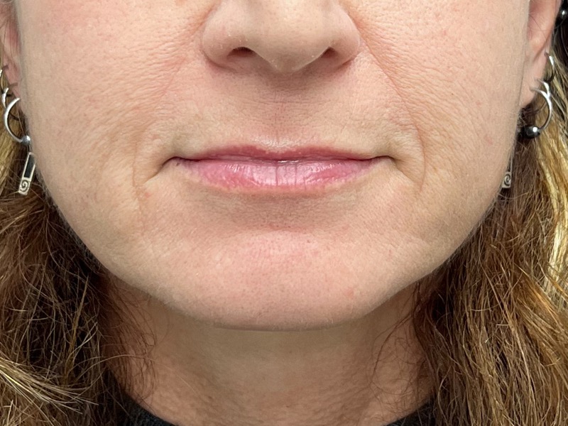 Lip Lift Before & After Image