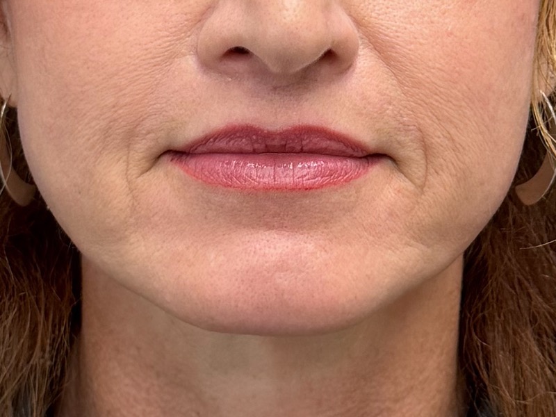 Lip Lift Before & After Image