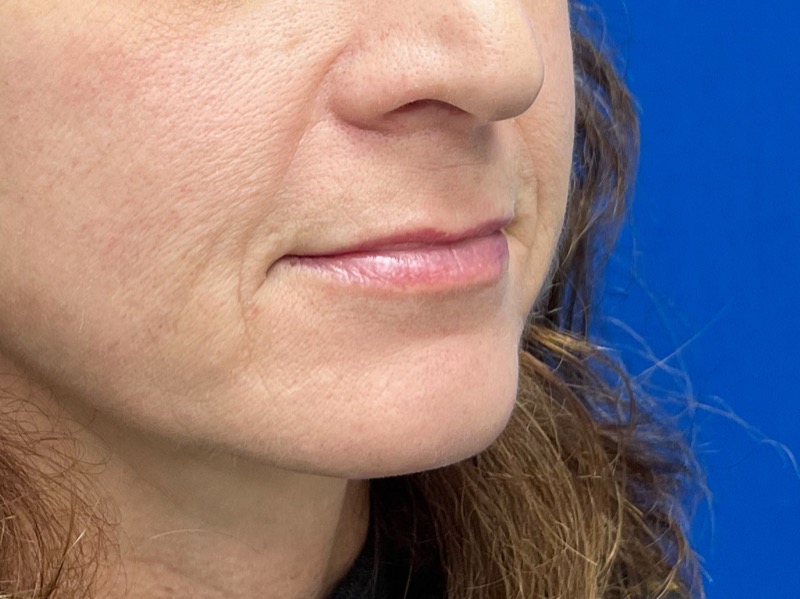 Lip Lift Before & After Image