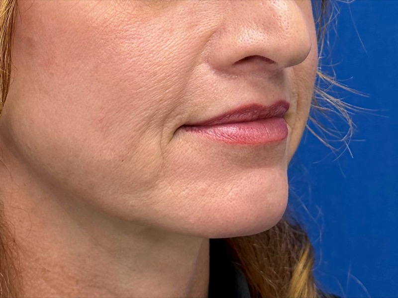 Lip Lift Before & After Image