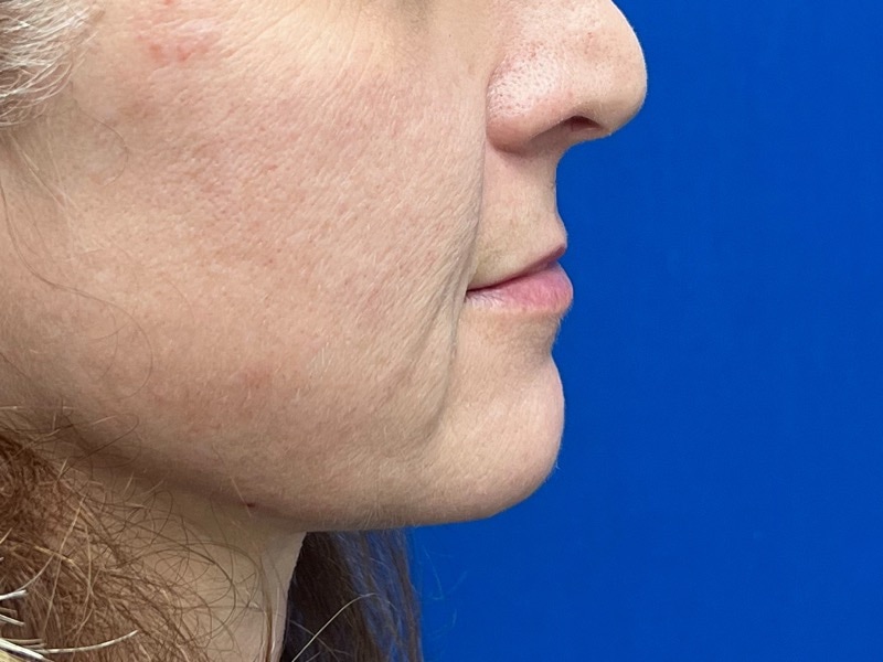 Lip Lift Before & After Image